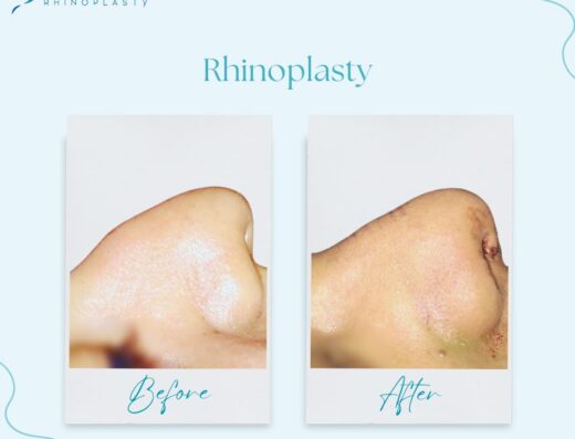 Dr.Ahmed Walaa Rhinoplasty