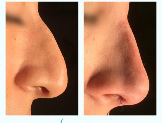 Dr.Ahmed Walaa Rhinoplasty