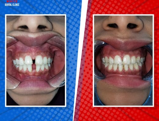 وايت لطب الاسنان